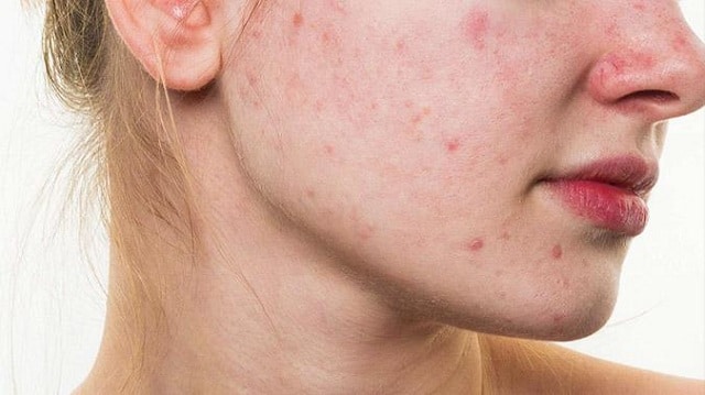 Làm sao để hết mụn và ngăn ngừa sự tấn công của mụn trên da mặt