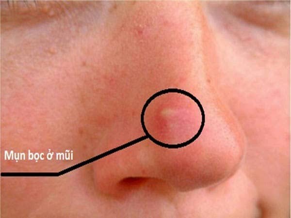 Mụn bọc xuất hiện ở mũi và nhiều vị trí khác trên khuôn mặt