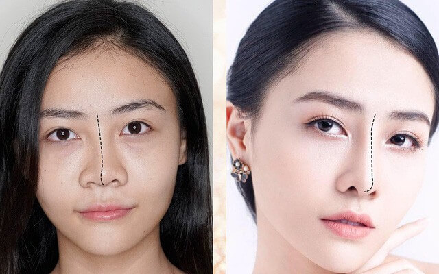 Phẫu thuật nâng mũi cho bạn vẻ đẹp hoàn thiện hơn