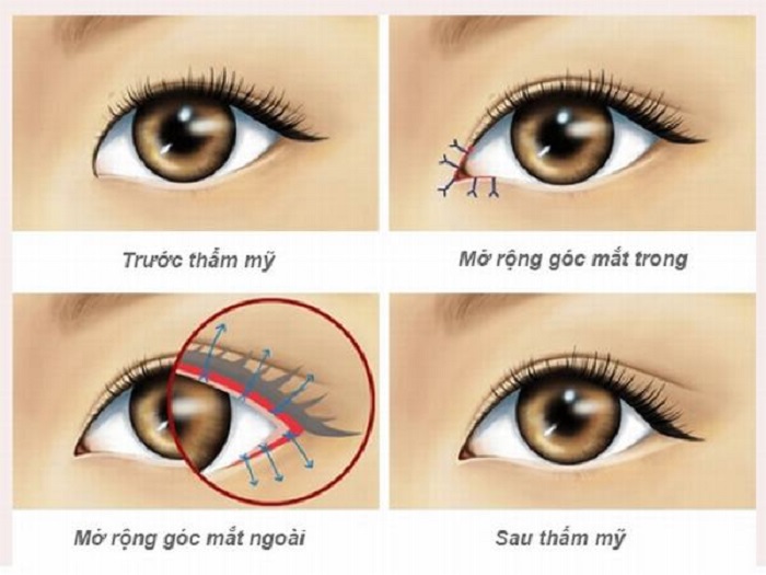 Sự khác biệt giữa mắt phượng và mắt hai mí