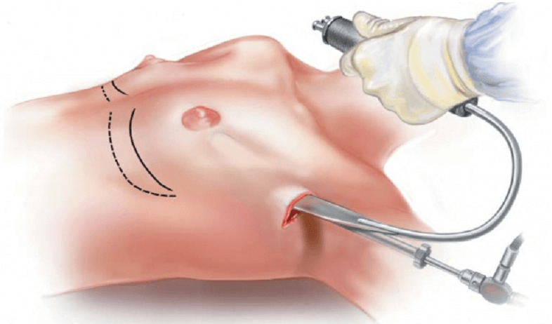 Hình ảnh minh họa phẫu thuật nâng ngực bằng nội soi.