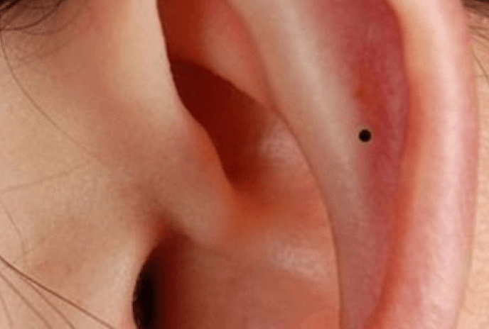 Nốt ruồi xuất hiện trong tai ở nam giới.