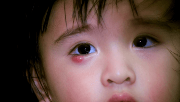 Lẹo mắt có thể xuất hiện ở mọi lứa tuổi kể cả trẻ em.