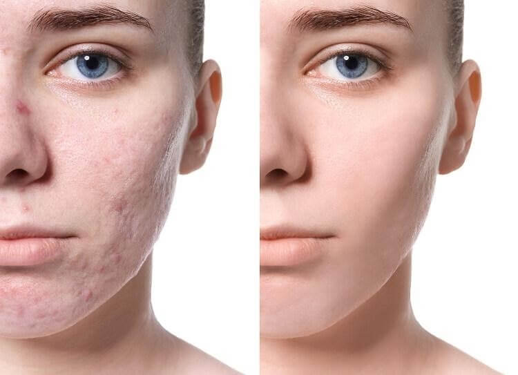 Trước và sau khi sử dụng kem trị sẹo rỗ