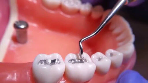 ưu điểm trám răng bằng amalgam