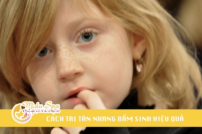 Cách trị tàn nhang bẩm sinh