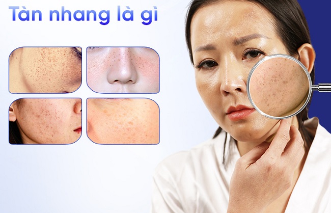 tàn nhang là gì?