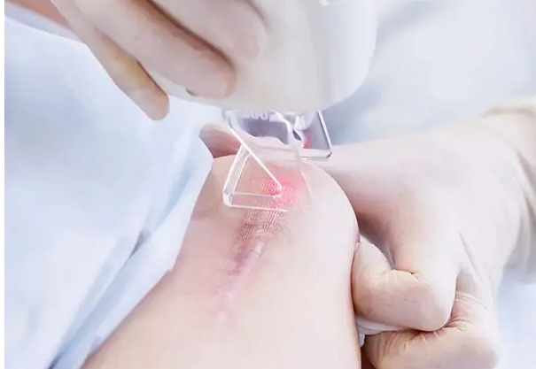 Trị sẹo lồi ngứa bằng phương pháp Laser