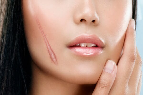 Trị sẹo lồi ngứa bằng phương pháp Laser