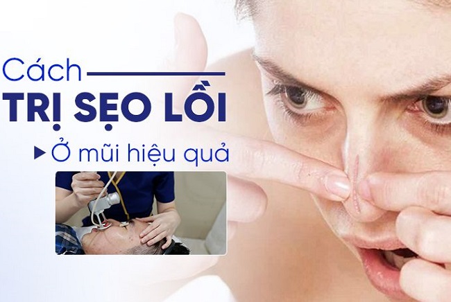 Trị sẹo lồi ở mũi Thủ Đức Quận 9