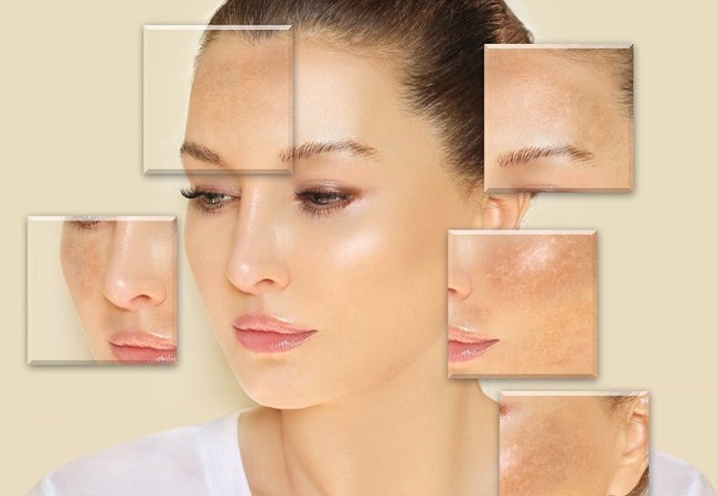 Cấy collagen căng có hết nám không