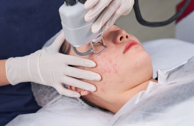 Trị mụn tận gốc Quận 3 Quận 4 Quận 5