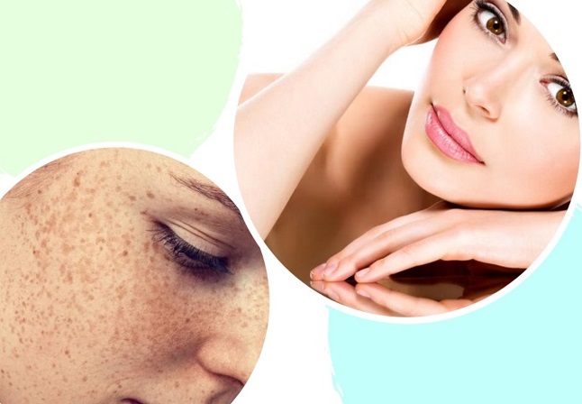 Trị tàn nhang bằng laser Quận 3 Quận 4 Quận 5