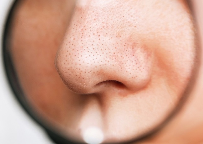 Trị mụn cám Quận 3 Quận 4 Quận 5