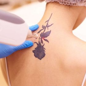 Xóa hình xăm Quận 3 Quận 4 Quận 5