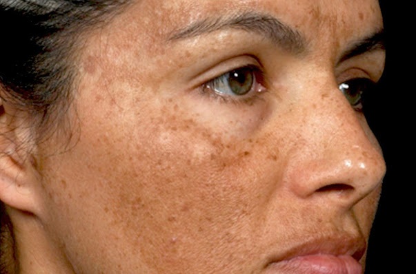 Nám da tuổi trung niên