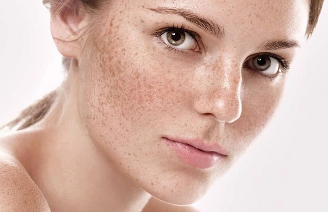 Phác đồ điều trị nám chuẩn y khoa