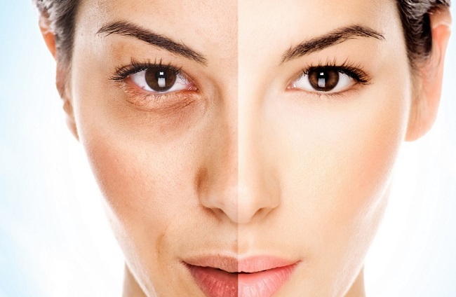 Sự khác biệt giữa điều trị nám da tại nhà và tại Spa