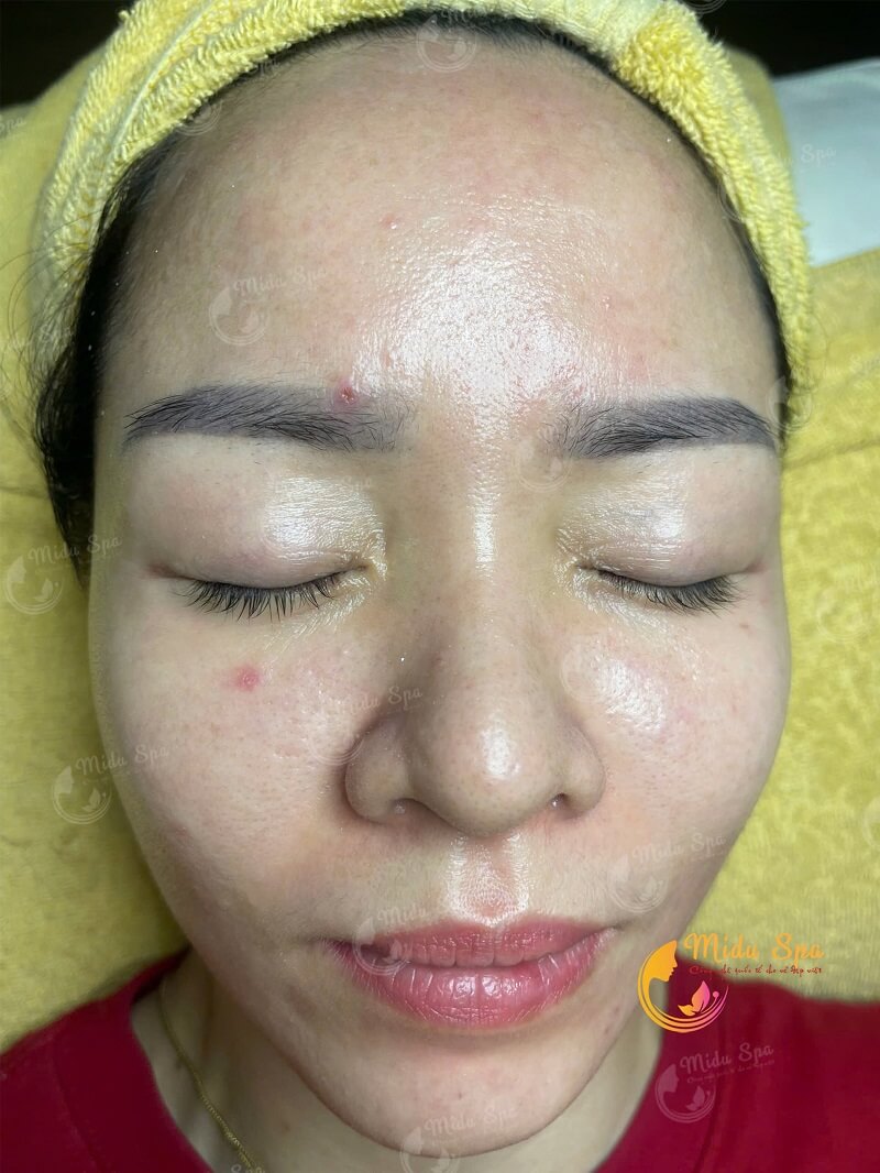 Dịch vụ trị nám tàn nhang