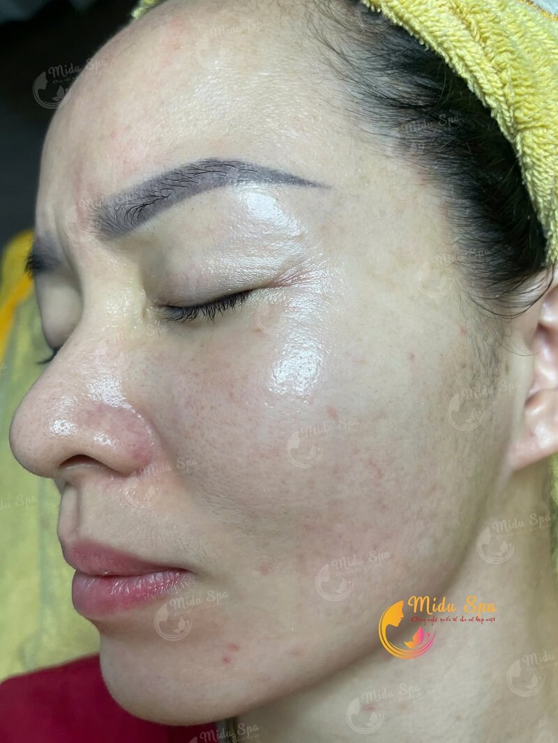 Quy trình thực hiện cách trị tàn nhang nám bằng công nghệ Utralight tại MiduSpa Thủ Đức